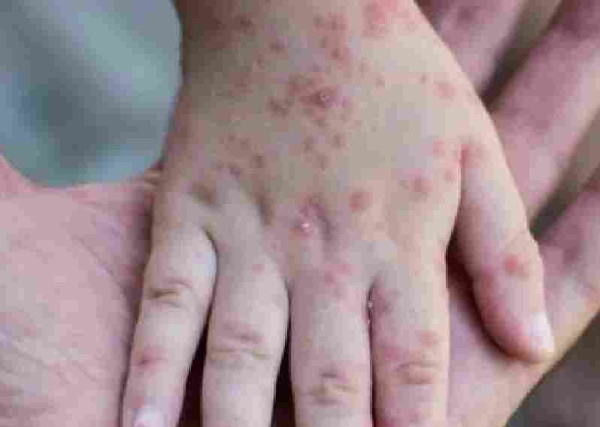 اعراض وطرق الوقاية من فيروس جدري القرود